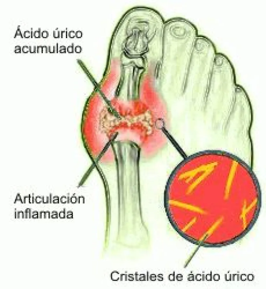 Salud: ¿qué es la Gota?