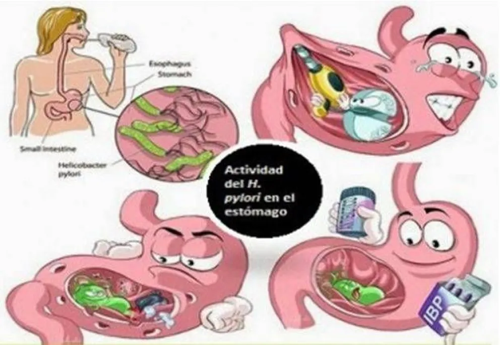 El Helicobacter pylori ¿Un causante de la gastritis?