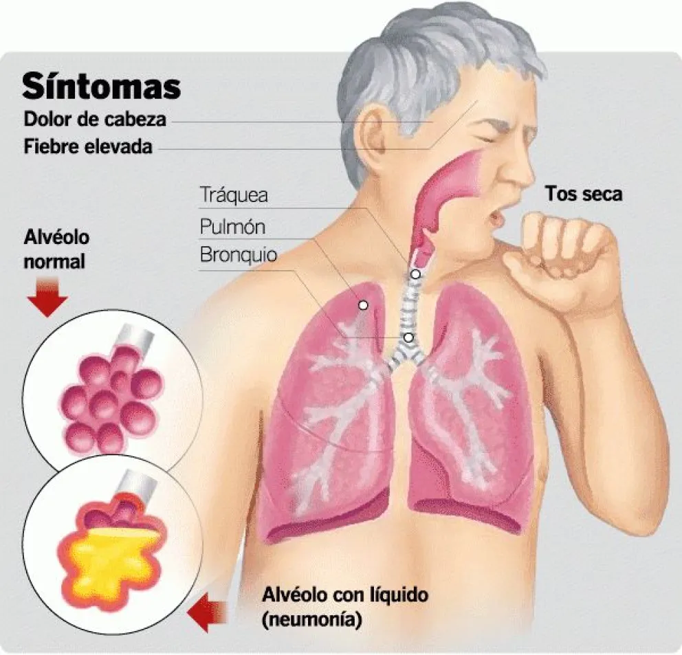 Neumonía, una enfermedad infecciosa frecuente