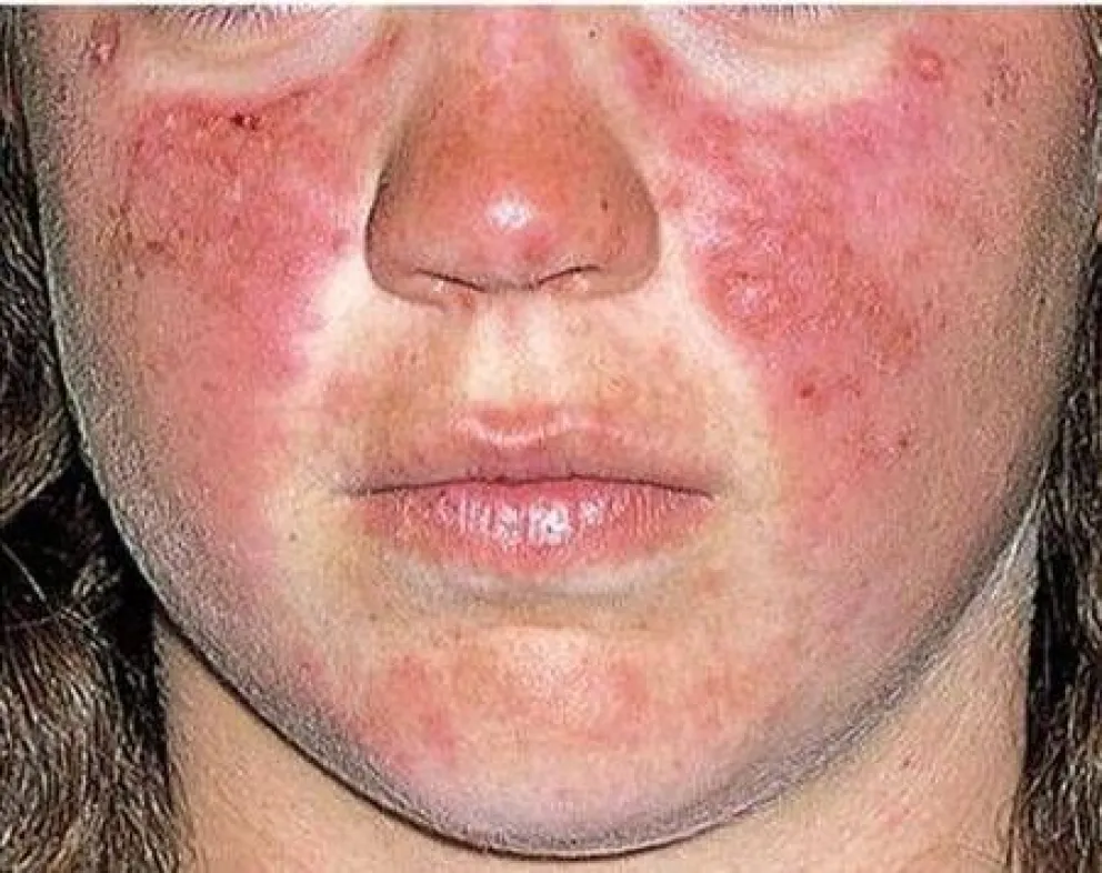 Qué es el Lupus Eritematoso Sistémico en niños