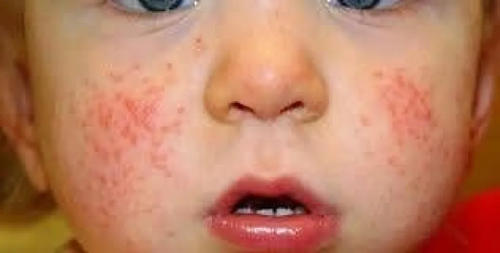 Qué es la Escarlatina