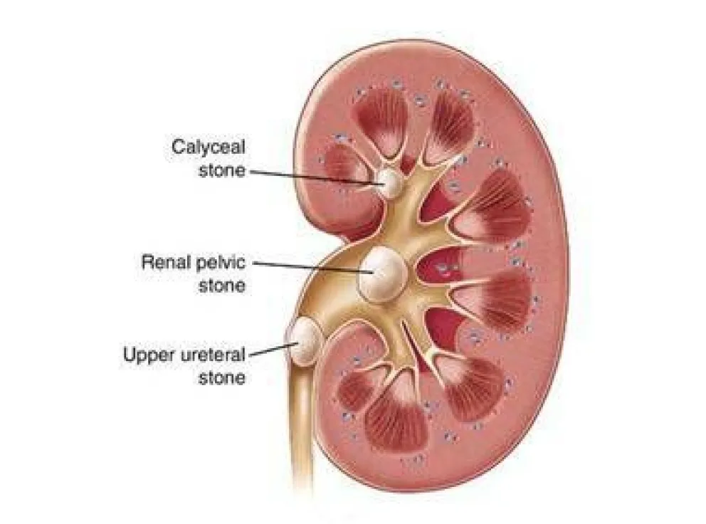 Los cálculos  renales