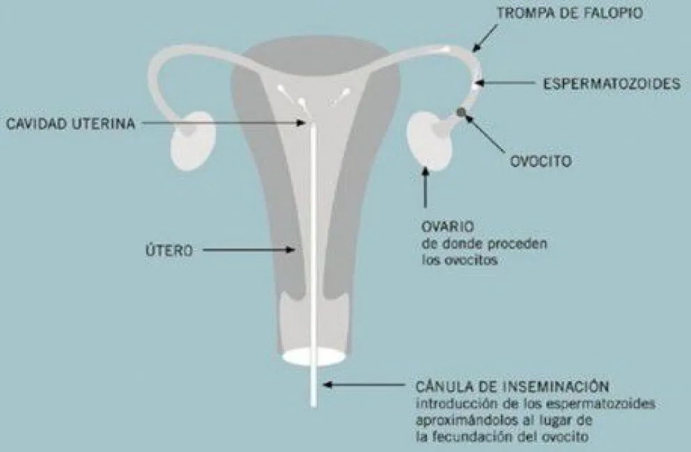 Esterilidad, infertilidad y técnicas de fertilización asistida