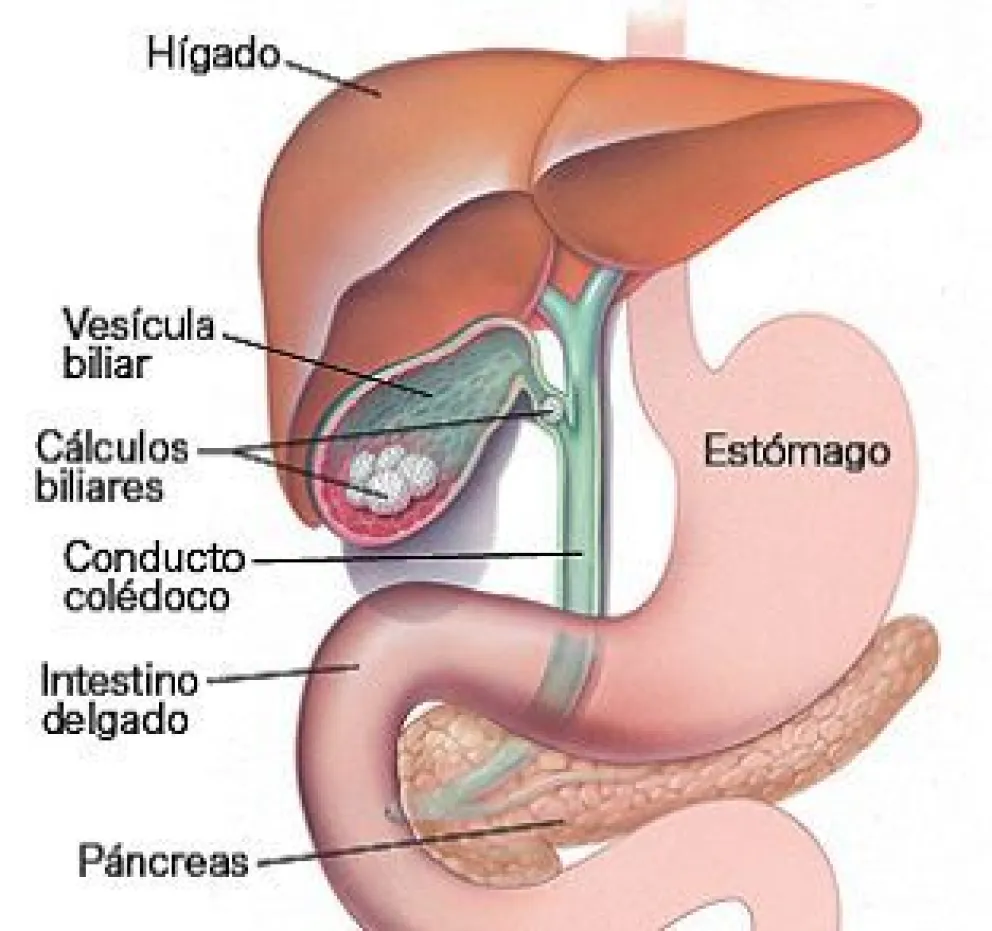 ¿Que sabemos de Litiasis Biliar?