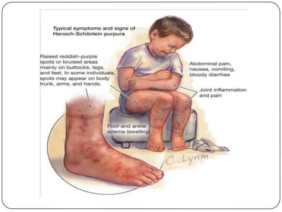 Púrpura de Schönlein-Henoch