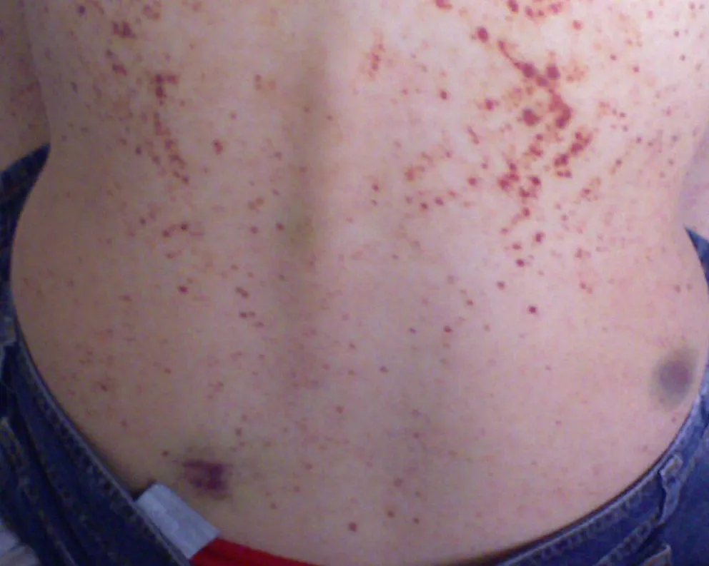 Qué es la “Púrpura trombocitopénica idiopática (PTI)”