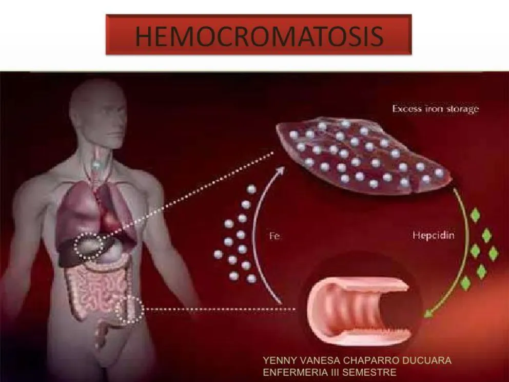 Hemocromatosis: cuando el hierro sobra…..