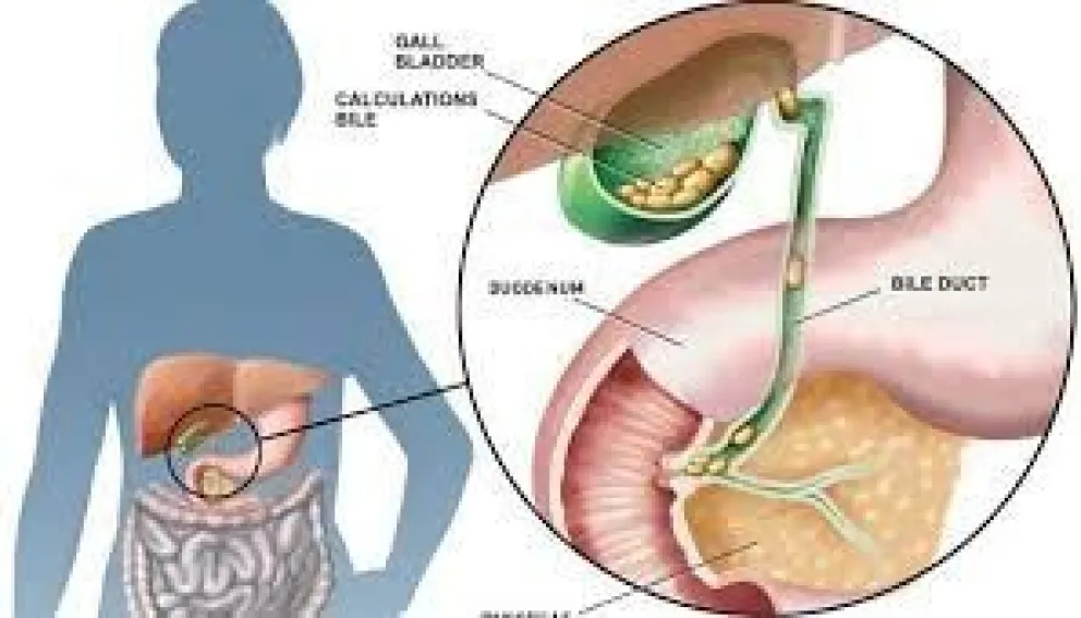 ¿Qué son los calculos biliares?