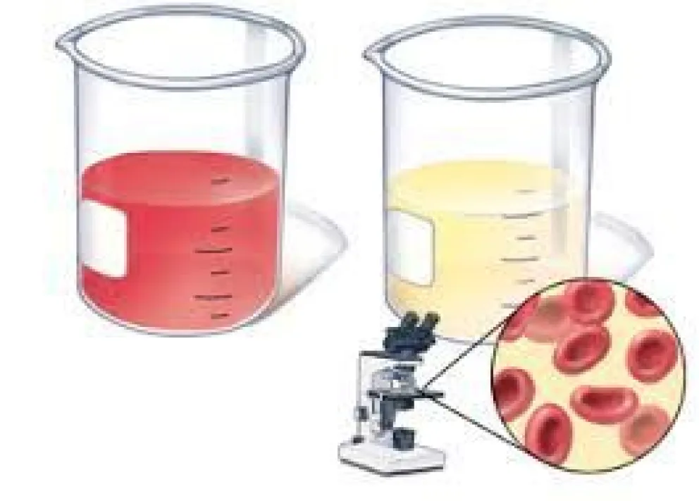 Qué es la "Hematuria"