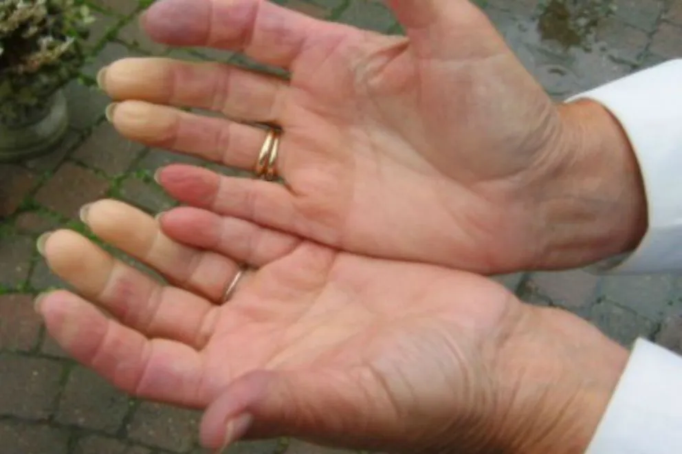 ¿Qué es la enfermedad de Raynaud?