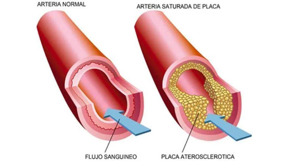 Colesterol alto, ¿Alcanza  la dieta para bajarlo?
